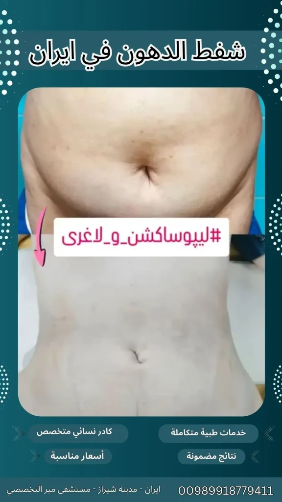 شفط الدهون في ايران