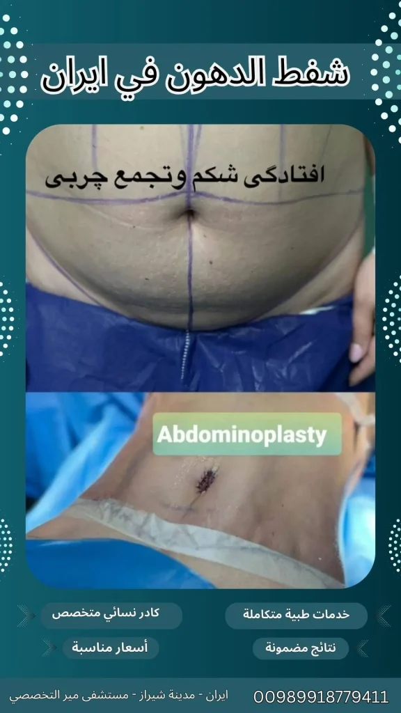 شفط الدهون في شيراز