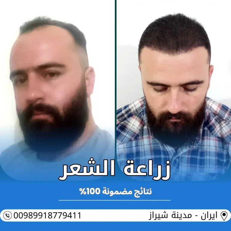 افضل مركز زراعة الشعر في ايران
