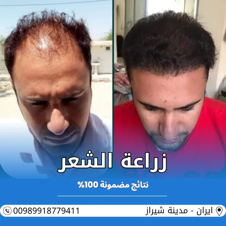 تكلفة زراعة الشعر في ايران