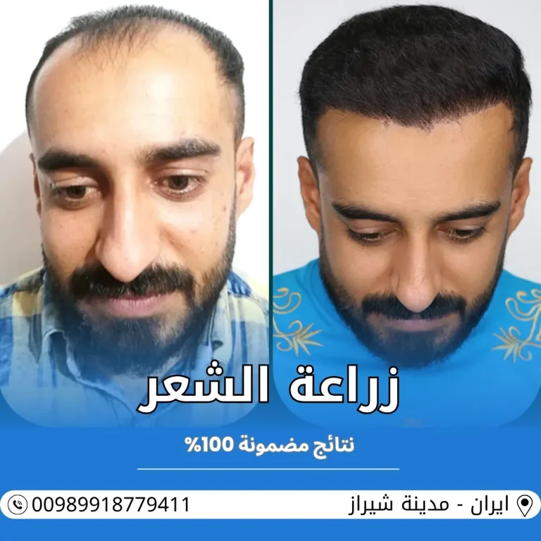تكلفة زراعة الشعر في ايران شيراز