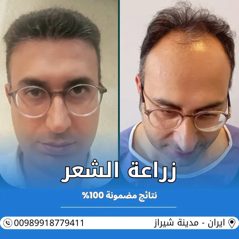 زراعة الشعر في ايران