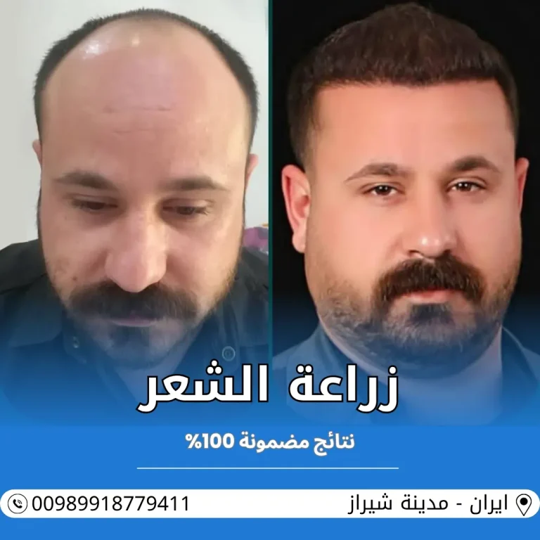 زراعة الشعر في ايران شيراز