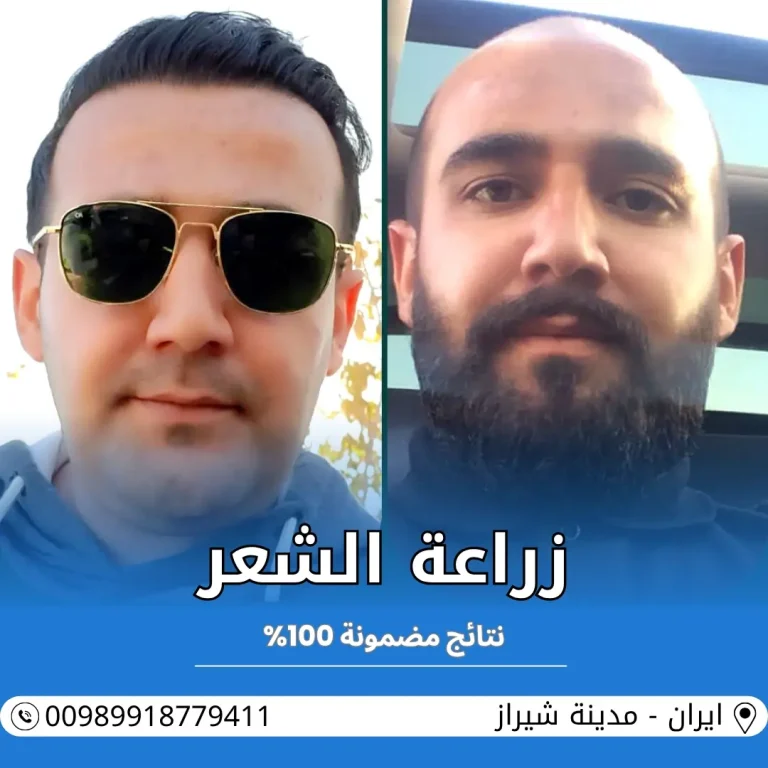 زراعة الشعر في شيراز