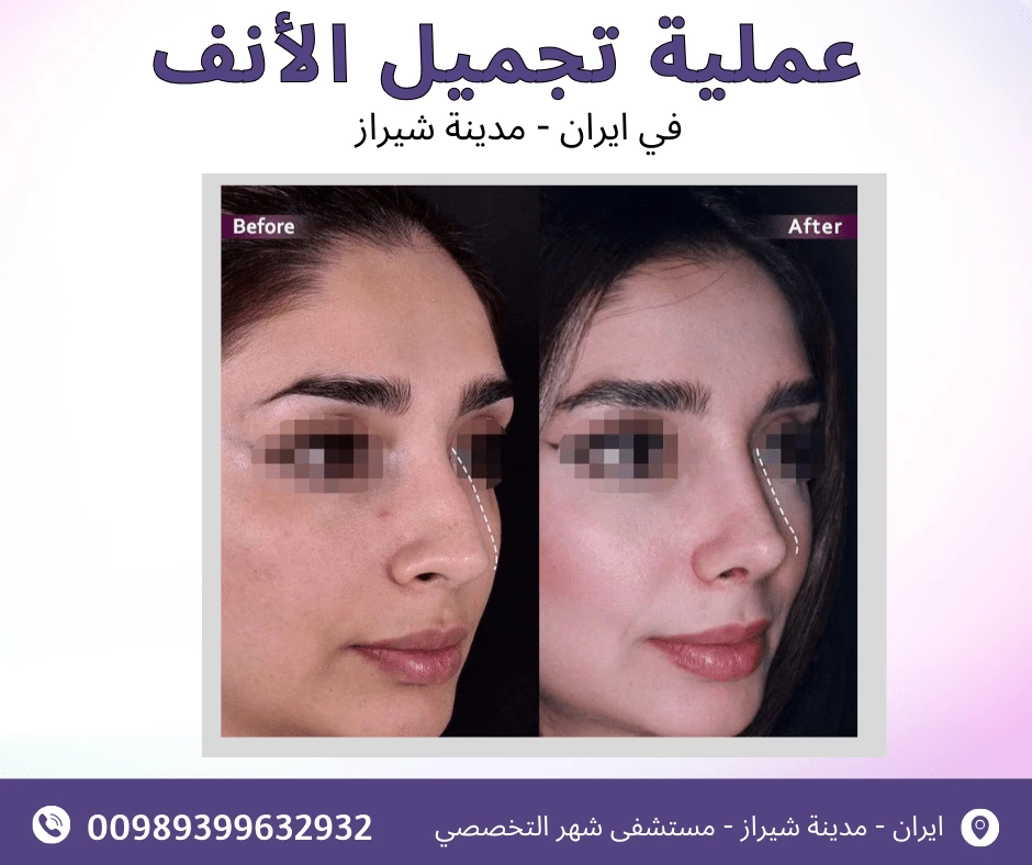 تكلفة تجميل الأنف في إيران