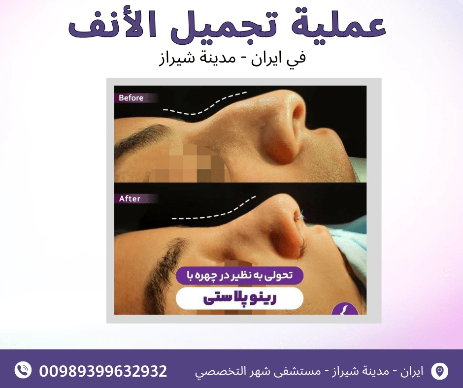 تكلفة-تجميل-الانف-في-ايران