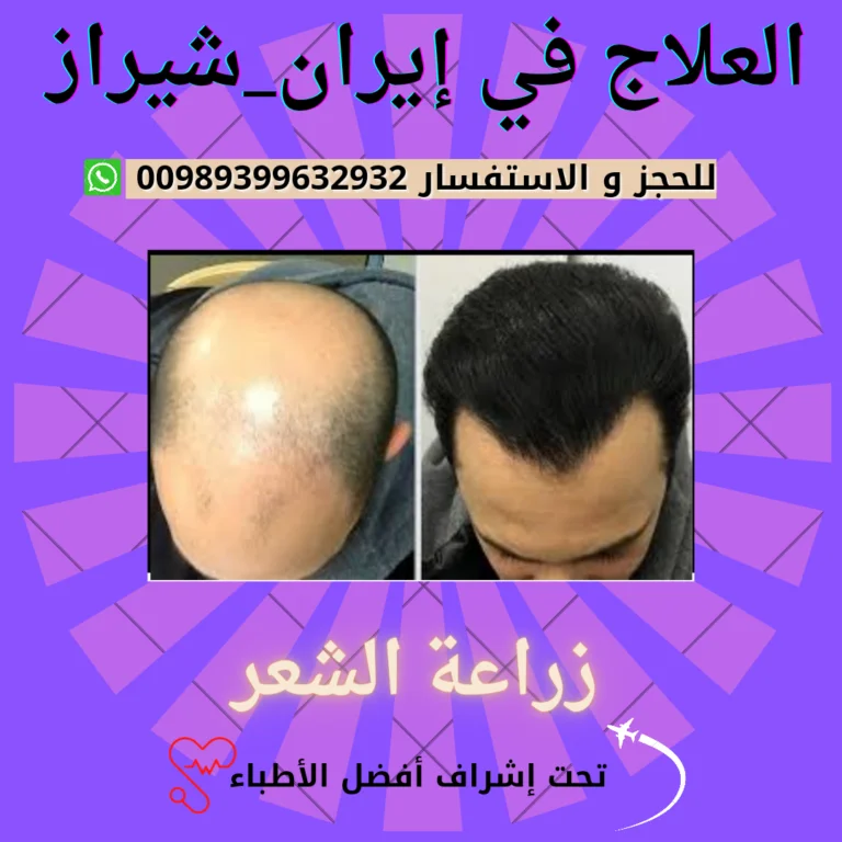 تكلفة-زراعة-الشعر-في-ايران