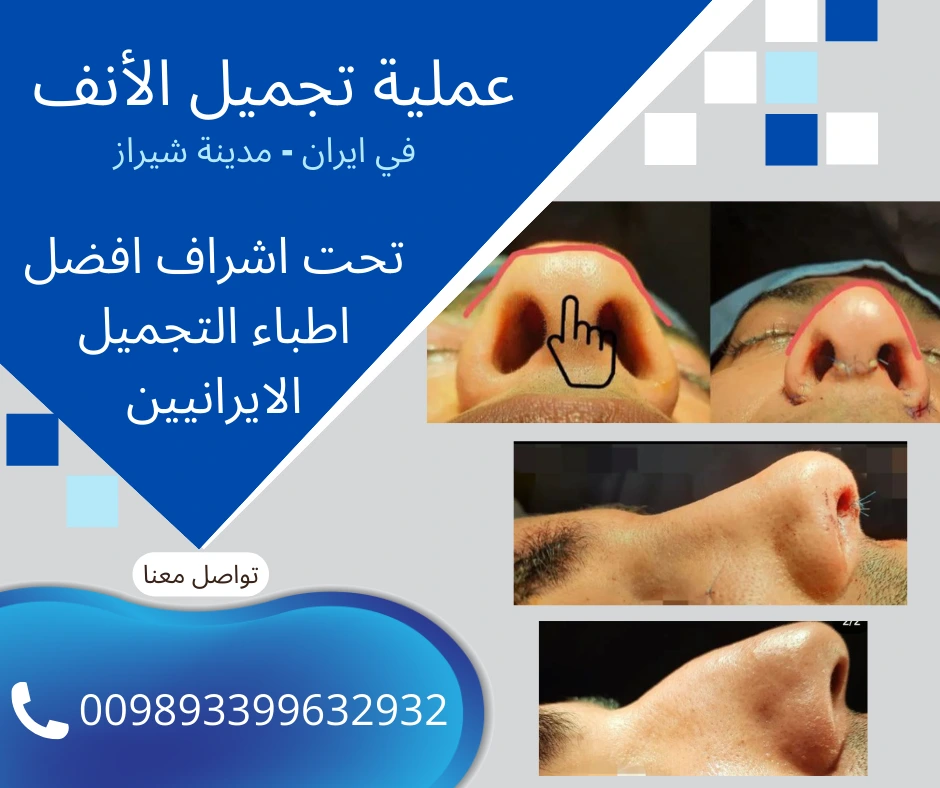 تكلفة-عملية-تجميل-الانف-في-ايران