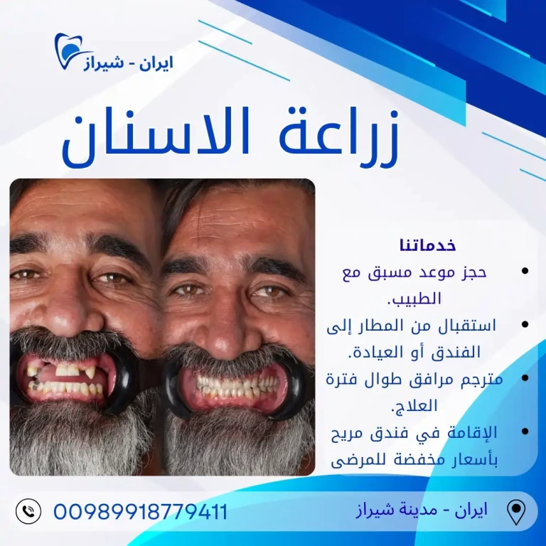 زراعة الأسنان في ايران