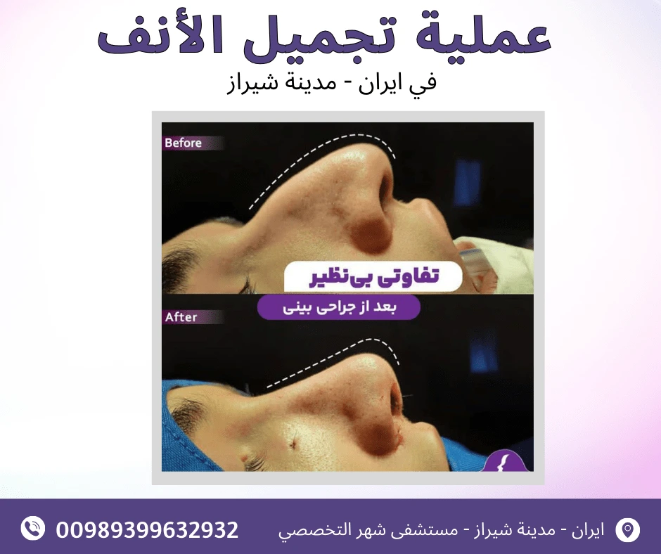 سعر-عملية-تجميل-الانف-في-ايران
