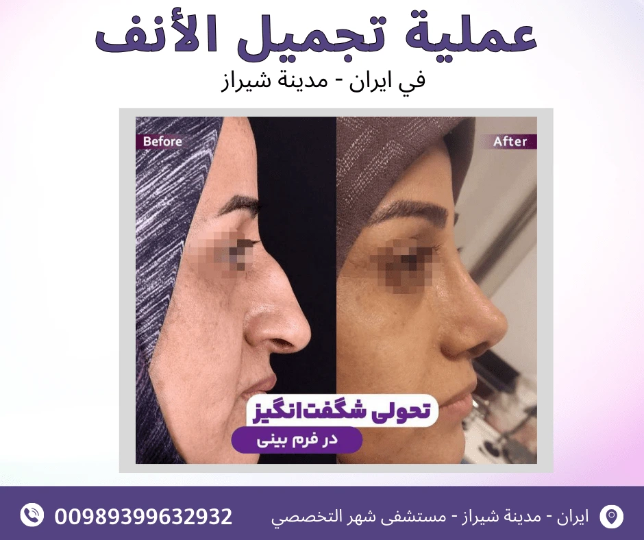 عملية-تجميل-الانف-في-ايران