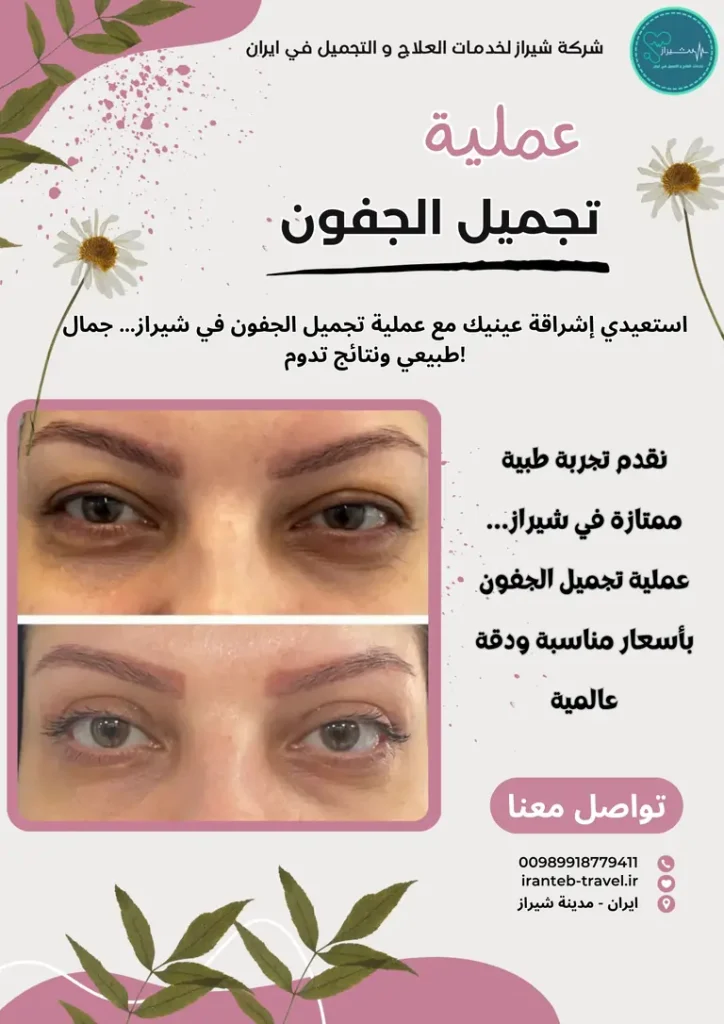 عملية تجميل الجفون في ايران