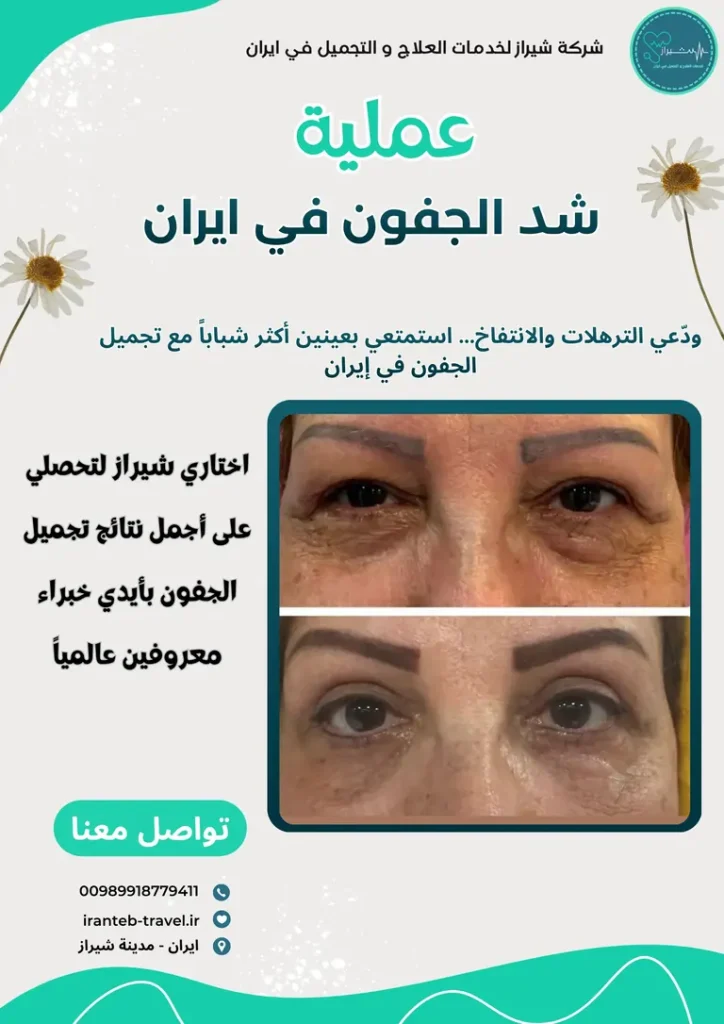 عملية شد الجفون في ايران
