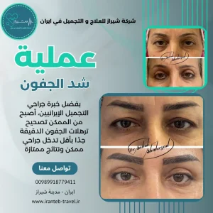 عملية شد الجفون في ايران