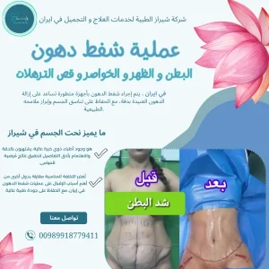 عملية شفط الدهون وشد البطن في إيران