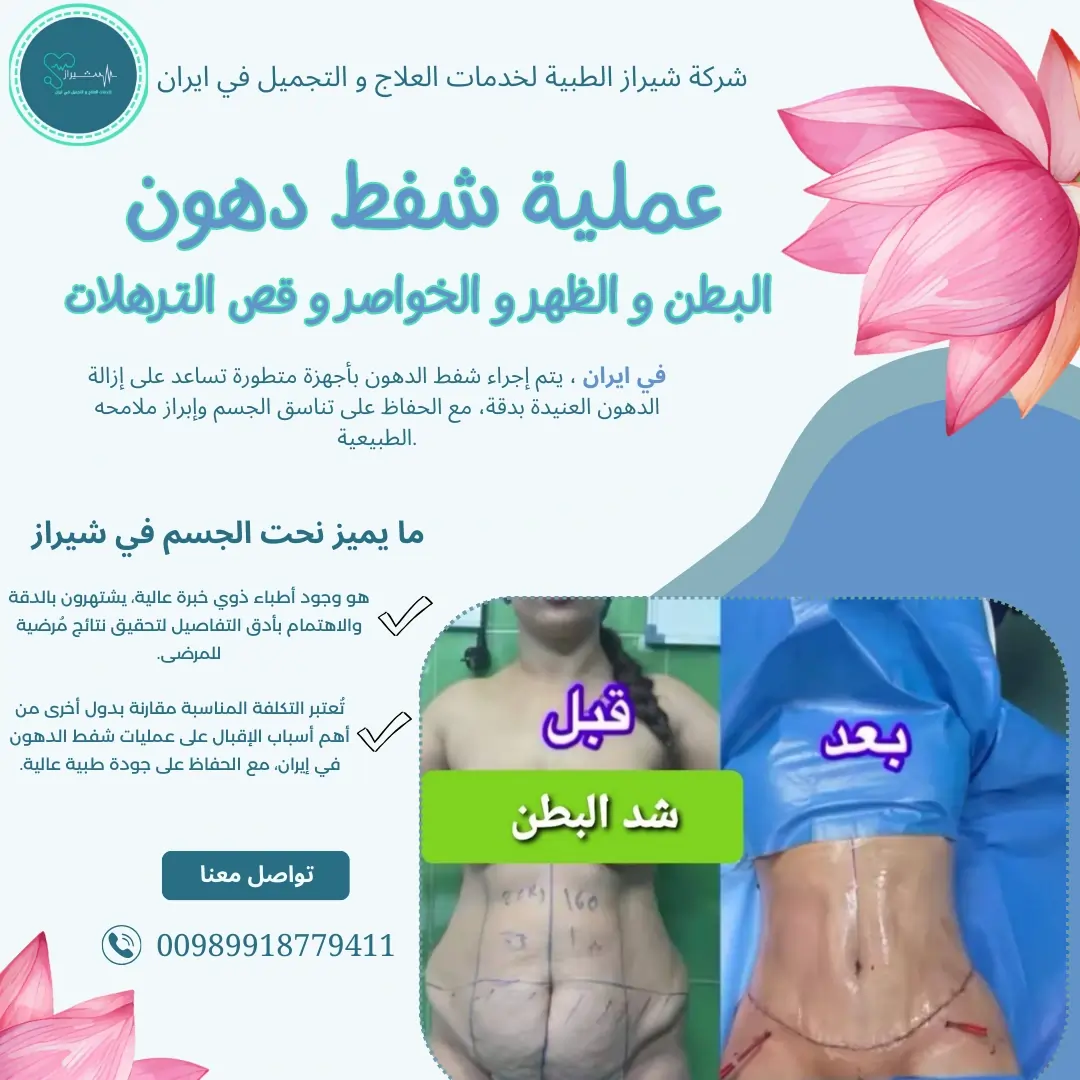عملية شفط الدهون وشد البطن في إيران