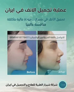 عملية تجميل الأنف في إيران